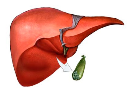 A krónikus cholecystitis definíciója, etiológiája, tünetei, diagnózisa és kezelése, őrzze meg