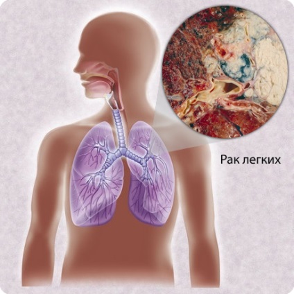 Lung tumoră, eurolab, oncologie