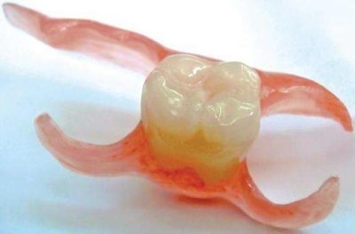 Metodele de bază ale protezei dinților fără răsucirea dinților adiacenți