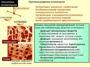 Csontritkulás a törések és kezelés törési kockázata után