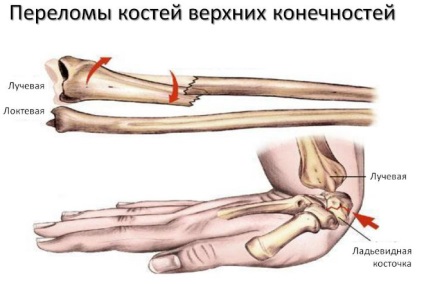 Osteoporoza după riscul fracturilor de fracturi și tratament