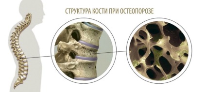 Osteoporoza după riscul fracturilor de fracturi și tratament