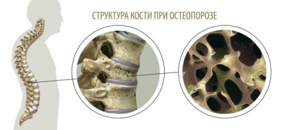 Остеопорозата след фрактура риск от фрактури и лечение