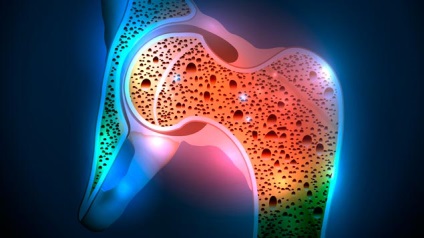 Osteoporoza - simptome, cauze, tratament, prevenire