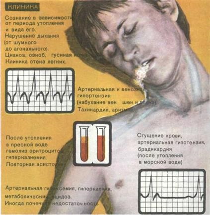 Insuficiență respiratorie acută cu obstrucție a căilor respiratorii