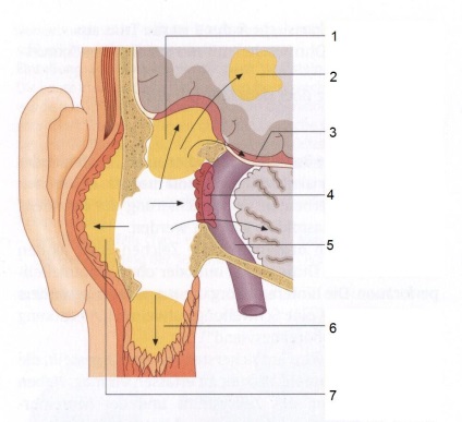 Otocén intracranialis szövődmények