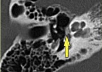 Otosclerosis, p.