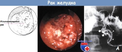 Belching cu cancer de stomac - simptomatologia cancerului de stomac este extrem de complexe și diverse, nu minți