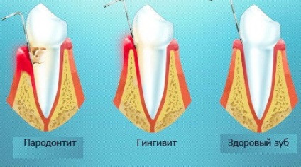 Simptomele parodontitei, foto, tratament