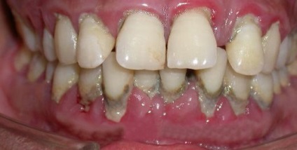 Simptomele parodontitei, foto, tratament