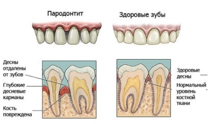 Simptomele parodontitei, foto, tratament