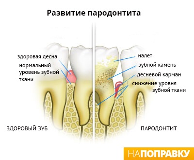 Parodontitis simptome și tratament