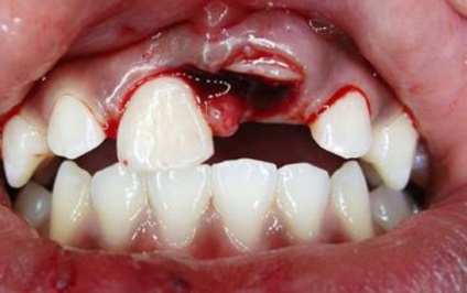 Fractura tehnicilor de terapie a rădăcinilor dentare, simptome, tratament