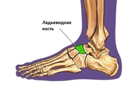 Fractură a piciorului cât de mult să umble într-o castă, simptome, tratament