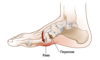 Fractura de picior cât de mult să umble într-o turnare, simptome, tratament