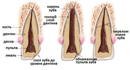 Fractura dintelui (rădăcină) - simptome, cauze și tratament