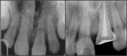 Fractura dintelui (rădăcină) - simptome, cauze și tratament