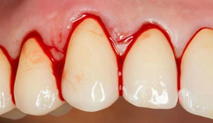 Fractura dintelui (rădăcină) - simptome, cauze și tratament
