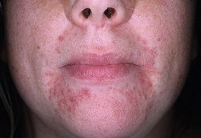 Perioralis dermatitis - a vénás és bőrbetegségek fóruma