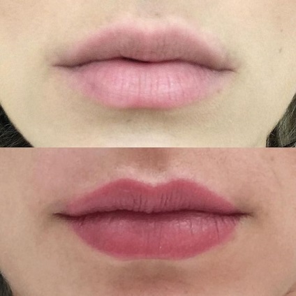 Az ajkak állandó felszívása 30 fénykép előtt és után