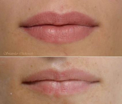 Az ajkak állandó felszívása 30 fénykép előtt és után