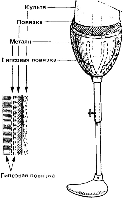 Proteză primară