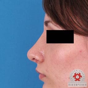 Plasticitatea columului nasului în clinica profesorului Pavluchenko, coloană de rinoplastie
