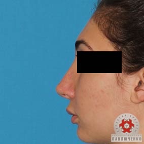 Plasticitatea columului nasului în clinica profesorului Pavluchenko, coloană de rinoplastie