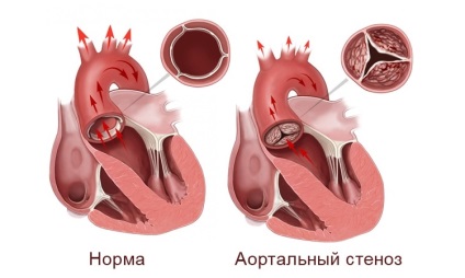De ce se dezvoltă stenoza aortică?