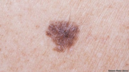 A karján lévő születési számok alapján előre jelezheti a melanoma kockázatát