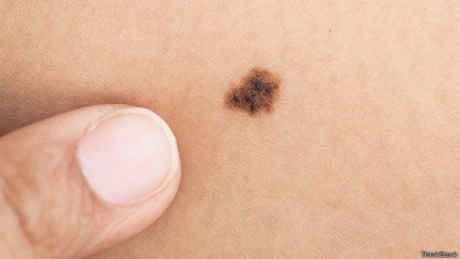 A karján lévő születési számok alapján előre jelezheti a melanoma kockázatát