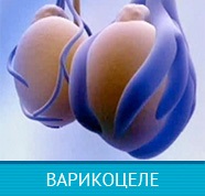 Consecințele și complicațiile cu hidrocele (testicule cu picătură)