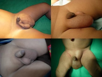 Consecințele și complicațiile cu hidrocele (testicule cu picătură)