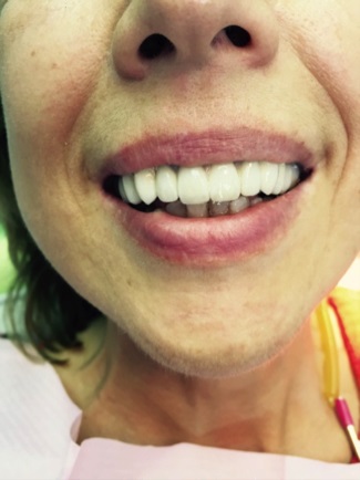 Experiență practică de utilizare a materialului trinia pentru proteze pe dinți vitali și devitalieni