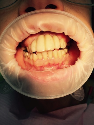 Experiență practică de utilizare a materialului trinia pentru proteze pe dinți vitali și devitalieni