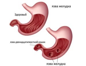 Megfelelő táplálkozás a gyomorra és a bélmenüre és az étkezésre