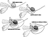 Prostatul (prostata), urologul meu