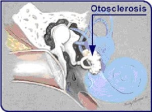 Cauzele și simptomele otosclerozei - când este necesară intervenția chirurgicală