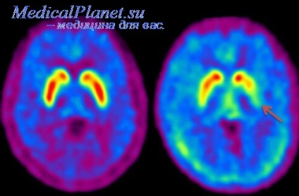 Semne de Parkinsonism