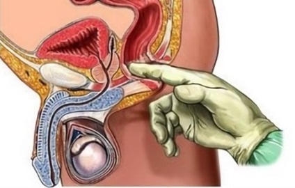 A prostatitis egyszerű megelőzése otthon az embereknél