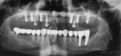 Proteze implantate - restabilirea funcției maxilarului maxilarului fără dinți