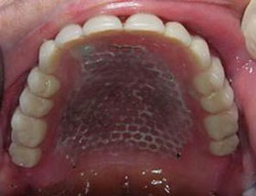 Proteze implantate - restabilirea funcției maxilarului maxilarului fără dinți