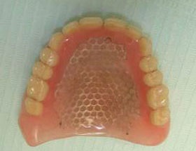 Proteze implantate - restabilirea funcției maxilarului maxilarului fără dinți