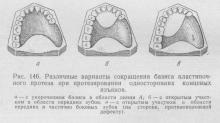 Protezele defectelor de un singur corp ale dentiției cu proteze cu arc și plăci,