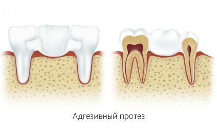 Протеза без пилинг