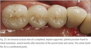 Dentiția protetică fără răsucirea dinților adiacenți