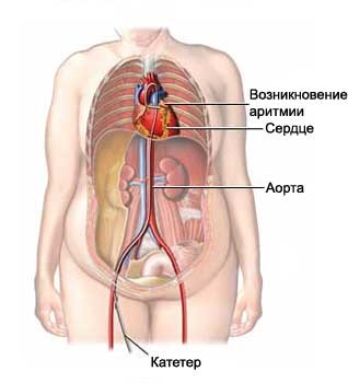 Ablația radiofrecventa în cele mai bune clinici din străinătate - cost și recenzii