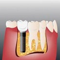 Calculul costului implanturilor dentare, adenta