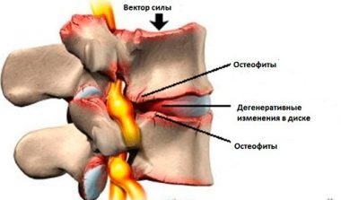 Cauzele și tratamentul osteofiturilor osoase