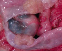 Cystadenom ovarian seros - cauze, simptome, diagnostic și tratament